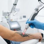 Zbliżenie na głowicę lasera celującą w czarny tatuaż na skórze.