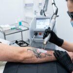 Kadr z gabinetu zabiegowego, skupiający się na głowicy nowoczesnego lasera pikosekundowego skierowanej na przedramię z wyblakłym, czarnym tatuażem.